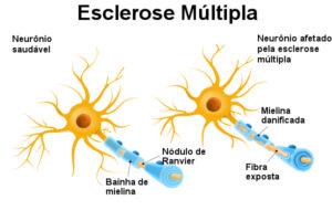 MEDICAMENTO OCREVUS (OCRELIZUMABE)